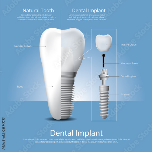 Human teeth and Dental implant Vector Illustration
