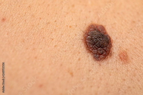 Dangerous nevus on skin - melanoma photo