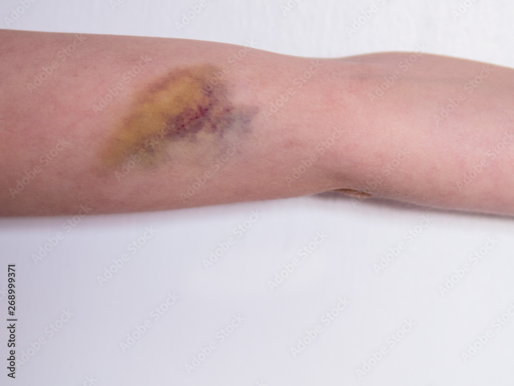 Fototapeta premium Bruise on a child arm. Close up.