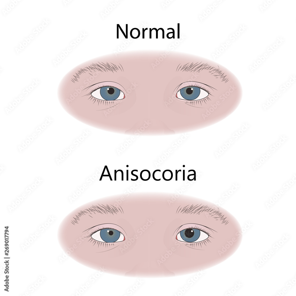 Anisocoria in infants, child, kid, pupils of different sizes. Vector