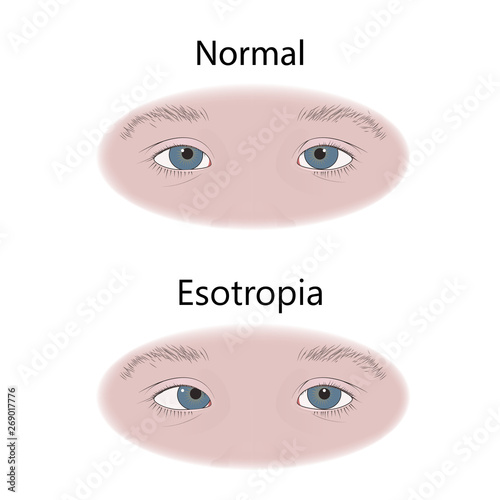 Strabismus in infants, child, kid. Cross-eyed, esotropia, inward eyes. Comparison with normal. Vector flat medical illustration.