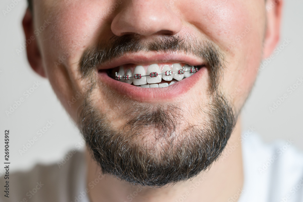 Close up of a young man with braces smiling. Macro shot of a young man with braces on a white background Close up of a young man with braces smiling. Macro shot of a young man with braces on a white background