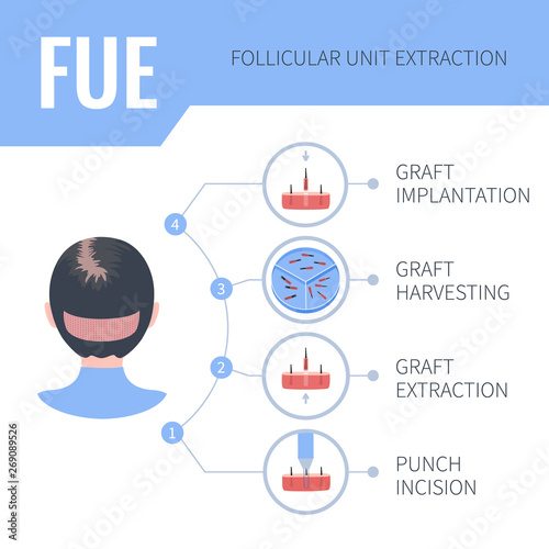 Hair transplant female alopecia treatment by FUE. 4 steps infographics. Stages of follicular unit extraction restoration surgery for women. Vector template for transplantation clinics.