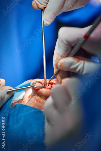 Surgeon and his assistant performing cosmetic surgery on nose in hospital operating room. Nose reshaping, augmentation. Rhinoplasty.