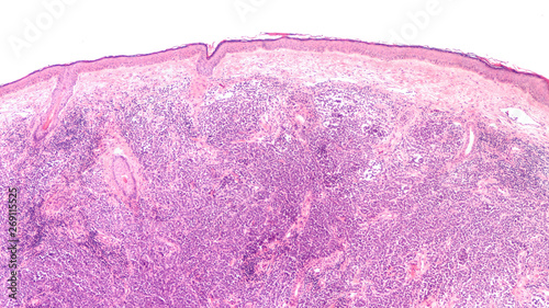 Microscopic image (photomicrograph) of a Merkel cell carcinoma, a highly aggressive type of skin cancer, derived from neuroendocrine cells, typically of the face, head or neck. photo