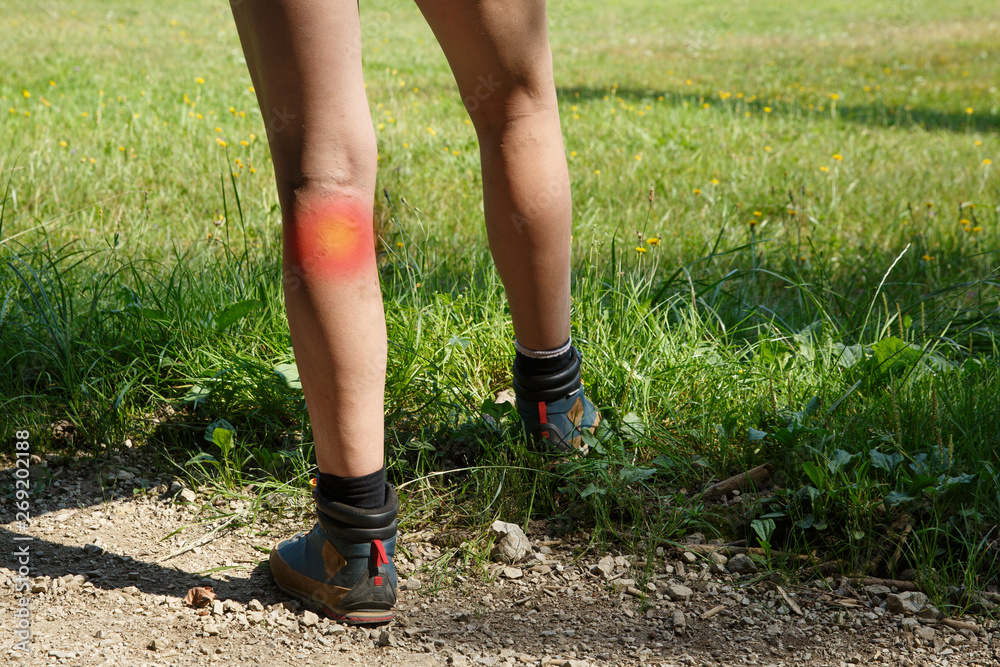 Woman with painful varicose veins and red dot effect.