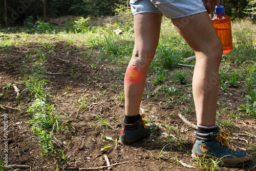 Woman with varicose veins on a hiking trip with red dot effect.