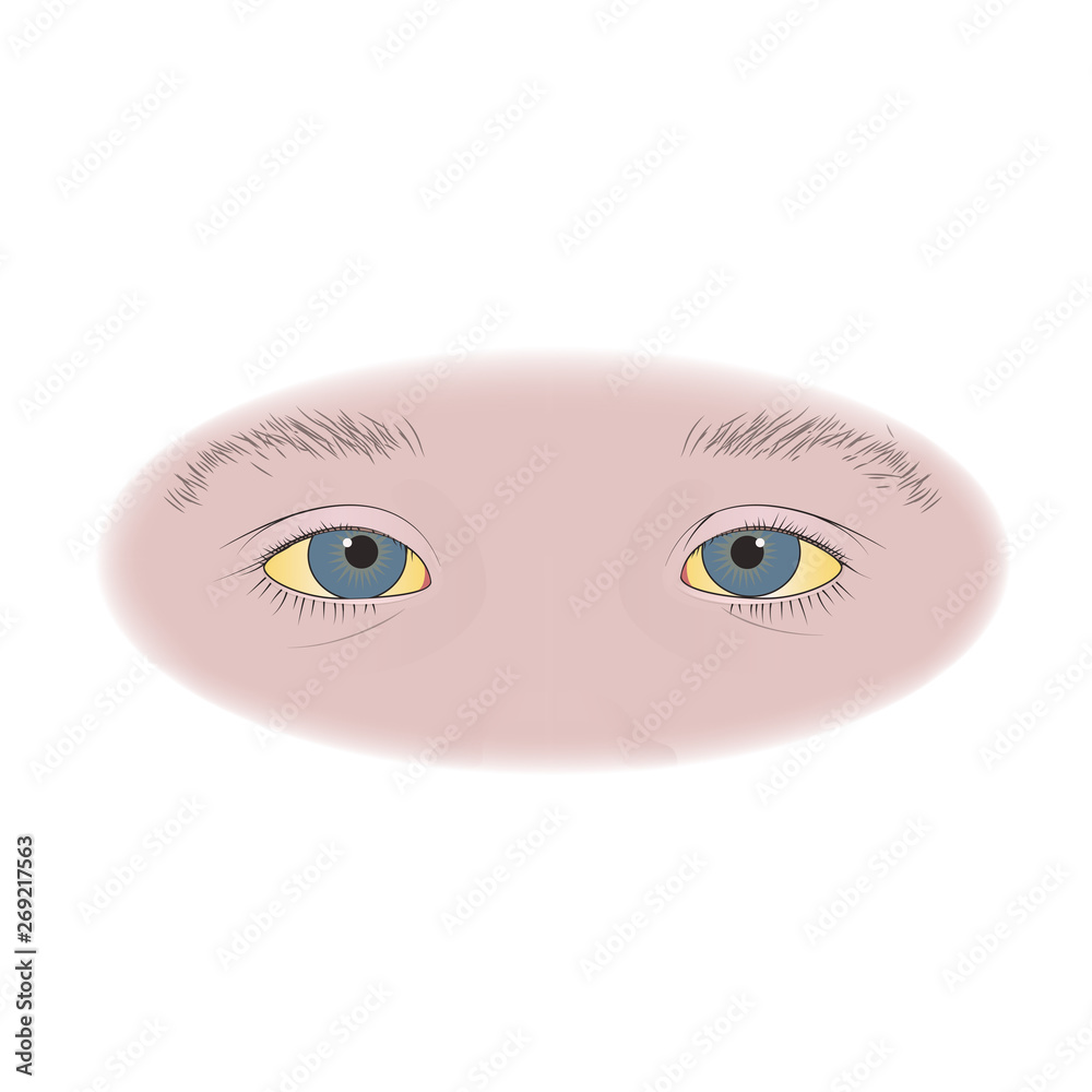 Yellow eyes in infants, kids, child. Vector flat medical illustration.
