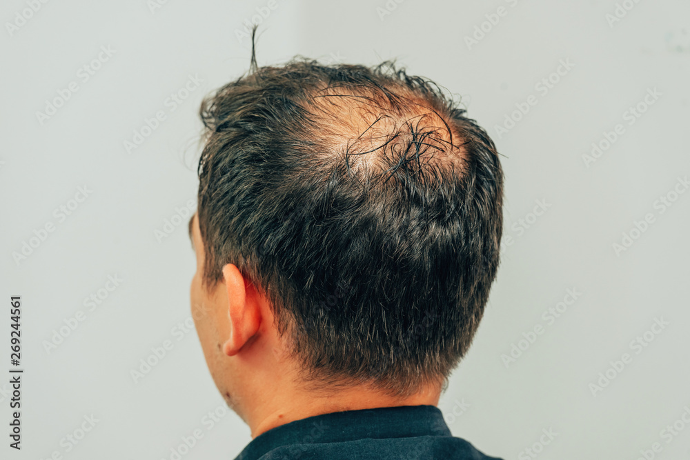 Mesotherapy of hair and head. Traces of injections on the head after  therapy. Male pattern baldness. Fighting hair loss in men. Men's bald head  at the top. Stock Photo | Adobe Stock