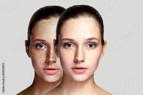 Closeup before and after portrait of beautiful brunette woman after laser treatment removing freckles on face looking at camera. makeup or cosmetology. indoor studio shot, isolated on gray background.