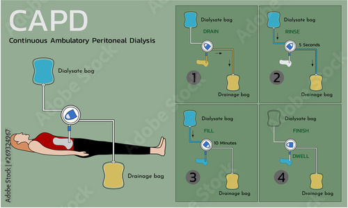 Continuous Ambulatory Peritoneal Dialysis (CAPD) , vector illustration