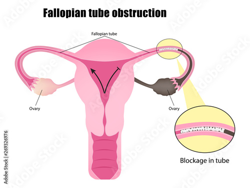 Obstruction of the fallopian tubes vector ESP10 photo