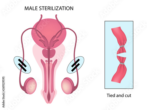 Male sterilization