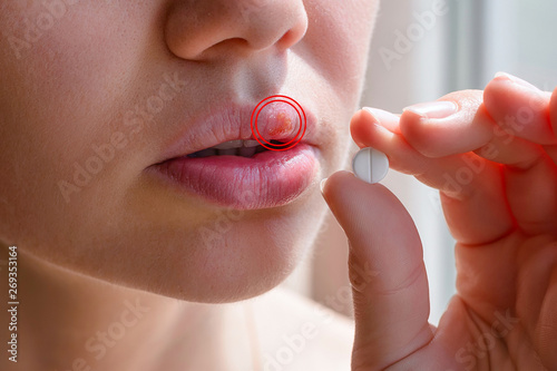 Part of a young woman's face with a virus herpes simplex on lips, treatment with pills photo