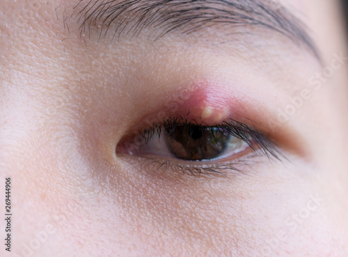 Tableau sur toile Close up of Asian young woman with brown eye with stye infection