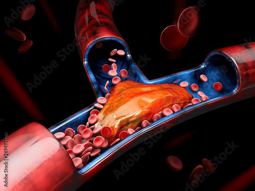 Schilderij op canvas 3d Illustration of Deep Vein Thrombosis or Blood Clots. Embolism