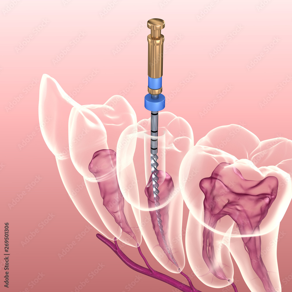 Endodontic root canal treatment process. Medically accurate tooth 3D ...