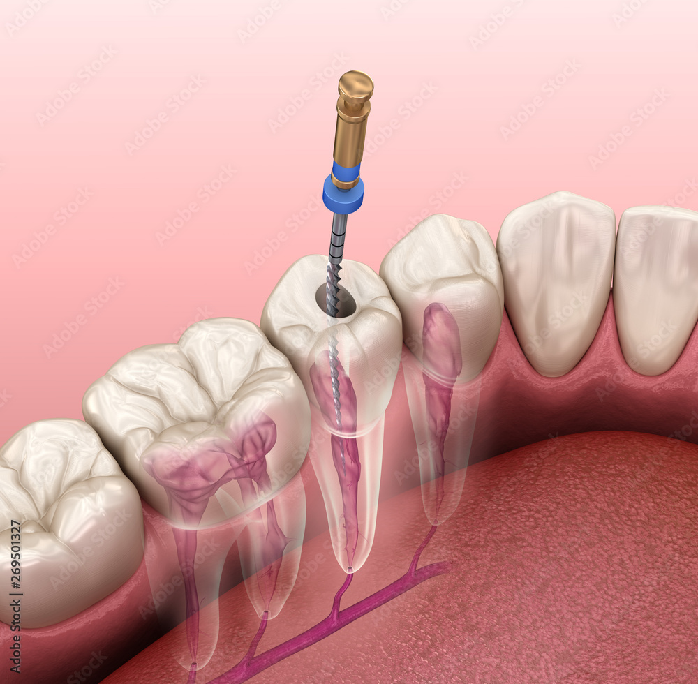 Stockillustratie Endodontic root canal treatment process. Medically