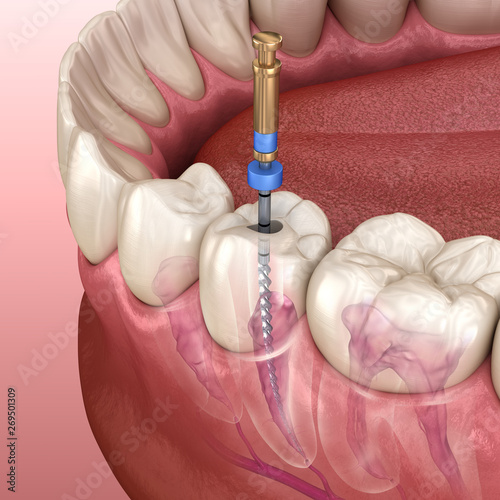 Photography Endodontic root canal treatment process