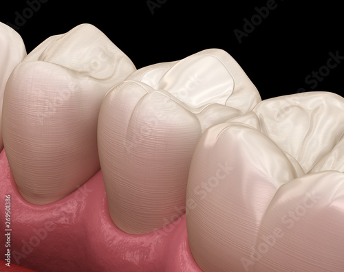 Fototapeta Naklejka Na Ścianę i Meble -  Premolar tooth restoration with filling. Medically accurate tooth 3D illustration.