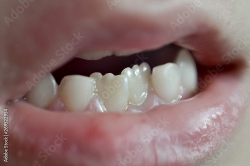Permanent and milk teeth on a child. Gums are swollen. on some teeth there is some dental plaque.