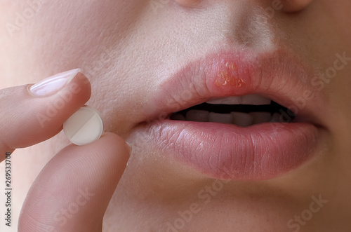 Fotografie Part of a young woman's face with a virus herpes simplex on lips, treatment with