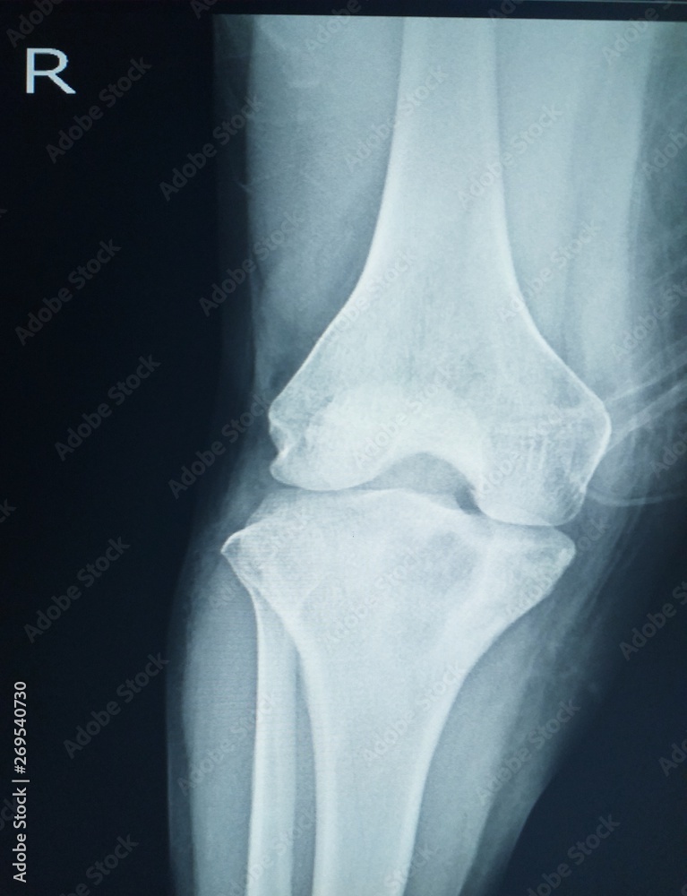 Xray Knee showing Localized mild osteosclerosis plus 4.5 cm lytic