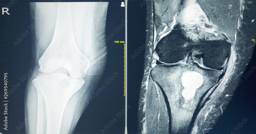 MRI OF THE RIGHT KNEE History Right knee pain, R/O TB arthritis or