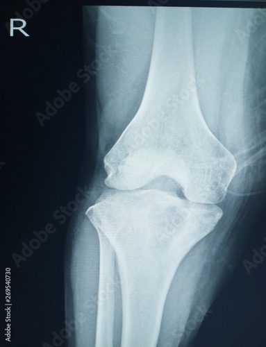 X-ray Knee showing Localized mild osteosclerosis plus 4.5 cm lytic lesion at irhgt upper tibia. No periosteal reaction is seen. Bone tumor is suspected. Normal right knee joint photo