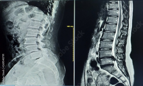 X-ray image Two views general x-ray and MRI lumbar spine showing Herniated nucleus pulposus of L4-L5 intervertebral disc,medical image concept.