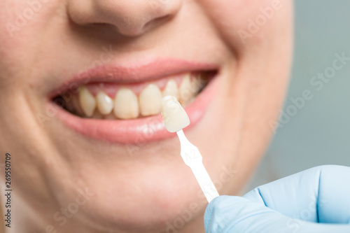 dentist using shade guide at woman's mouth to check veneer of tooth for bleaching