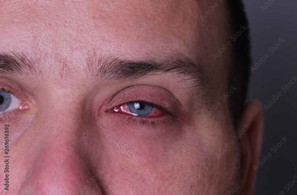 Close-up of conjunctivitis red eye Close-up of conjunctivitis red eye
