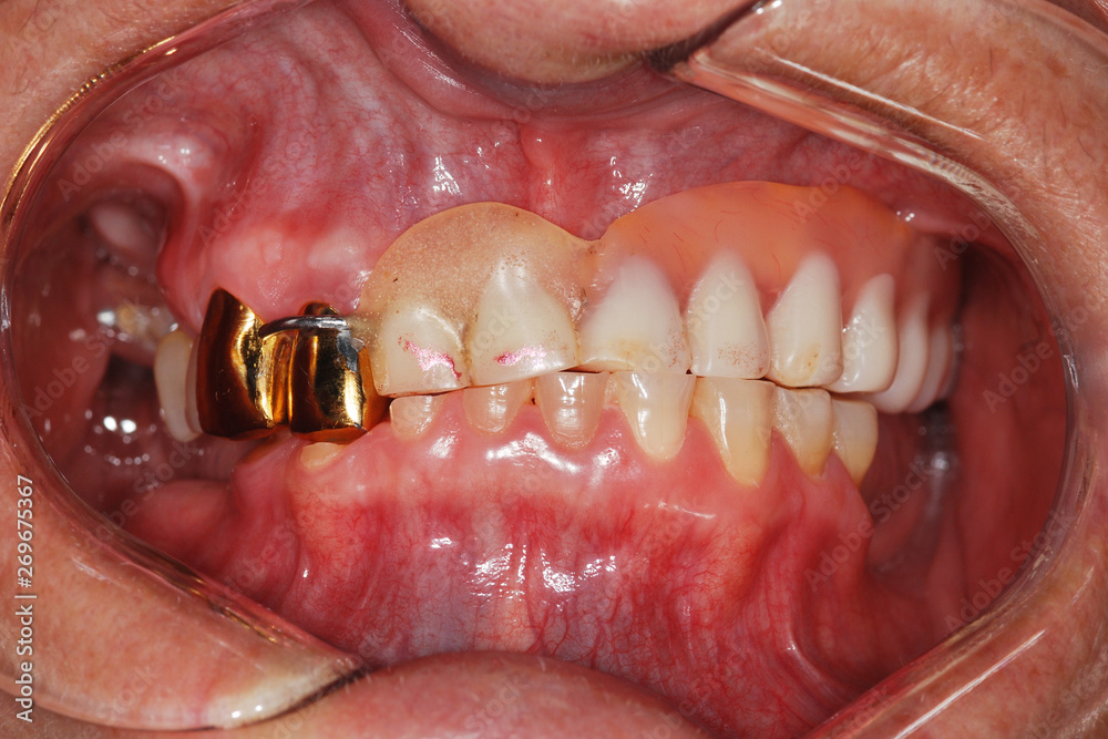 Dental treatment in the dental clinic. Restoration of teeth