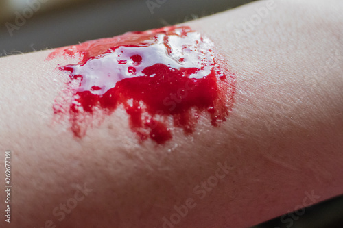 Blut Arm Selbstverletzung Ritzen