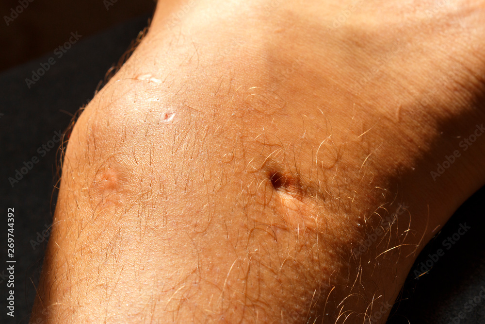 Scars on the legs of men. Selective focus of male human leg with scar from  Maffucci syndrome surgery Stock Photo