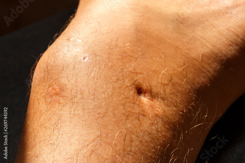 Scars on the legs of men. Selective focus of male human leg with scar from Maffucci syndrome surgery photo