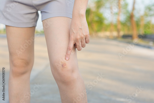 Bright bruise damage on knee of young woman. A girl rubs her fingers with a curative ointment in a bruised knee with a bruise. Pain concept close-hematology on the leg.bruise on the leg,Checking bruin