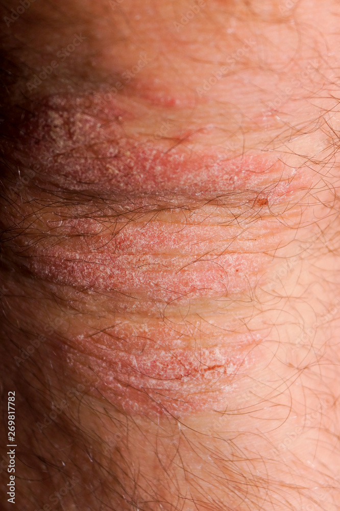 Fototapeta premium Psoriasis dry red and white irritation on the skin closeup.