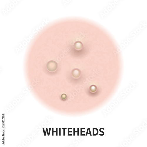 Whiteheads skin acne type vector icon. Skin disease acne whiteheads pimples type and face pore comedones