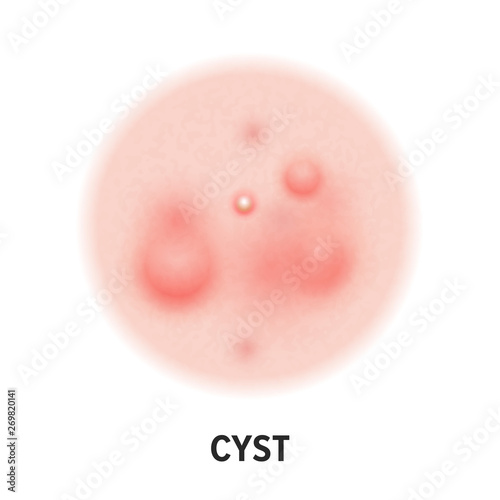 Cyst skin acne type vector icon. Skin disease acne cyst pimples type and face pore comedones