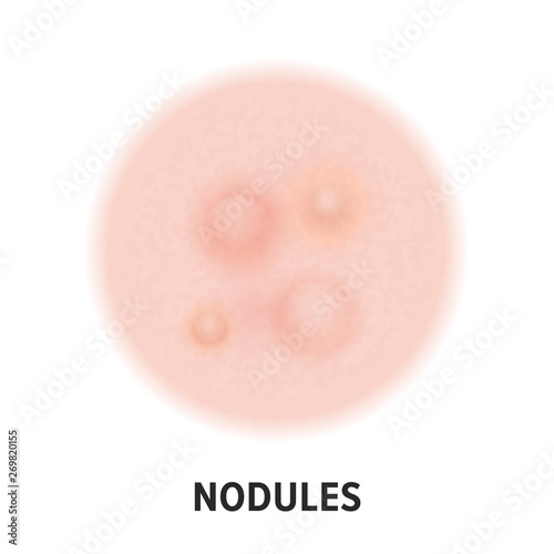 Nodules skin acne type vector icon. Skin disease acne nodules pimples type and face pore comedones