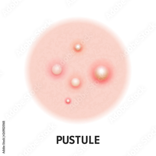 Pustule skin acne type vector icon. Skin disease acne pustules pimples type and face pore comedones