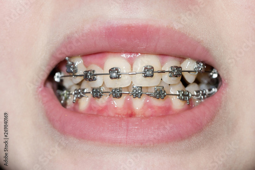 Orthodontic braces. Close up. Macro