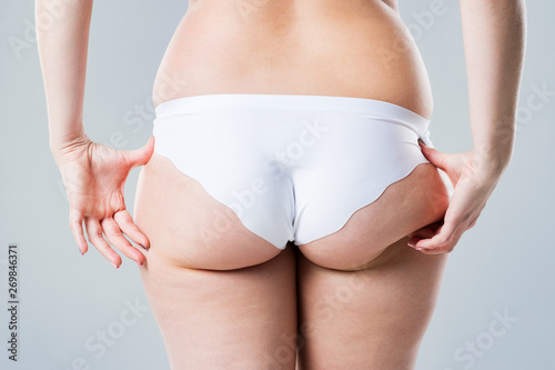 Overweight woman with fat legs and buttocks, obesity female body on gray background © staras