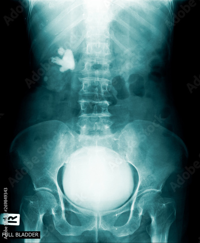 full bladder x-ray image photo