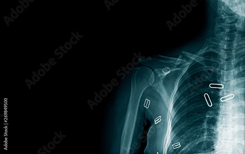 Obraz na płótnie x-ray image clavicle fracture