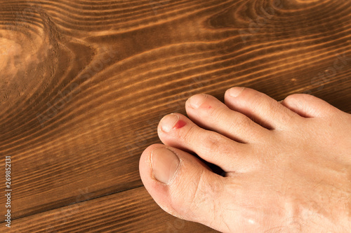The wound on his leg. A bloody blister on his finger. Close up. On a wooden background.