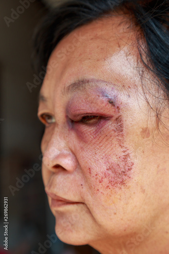Elderly injury to the eyelid