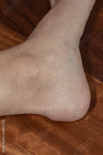 Heel affected with bursitis