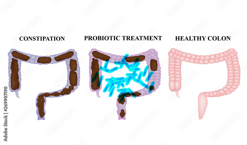 Vecteur Stock Treatment of constipation with probiotics. Lactobacillus.  Feces in colon. Infographics. Vector illustration on isolated background. |  Adobe Stock